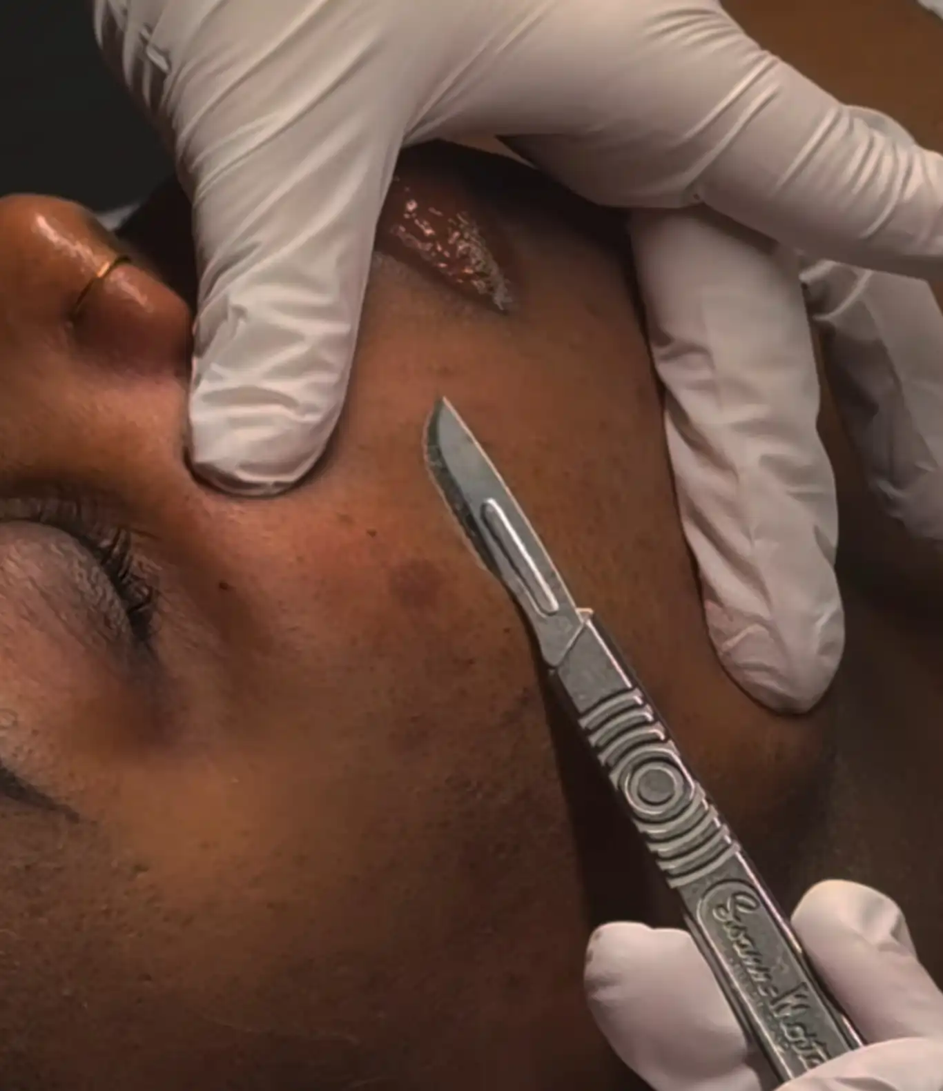 dermaplaning